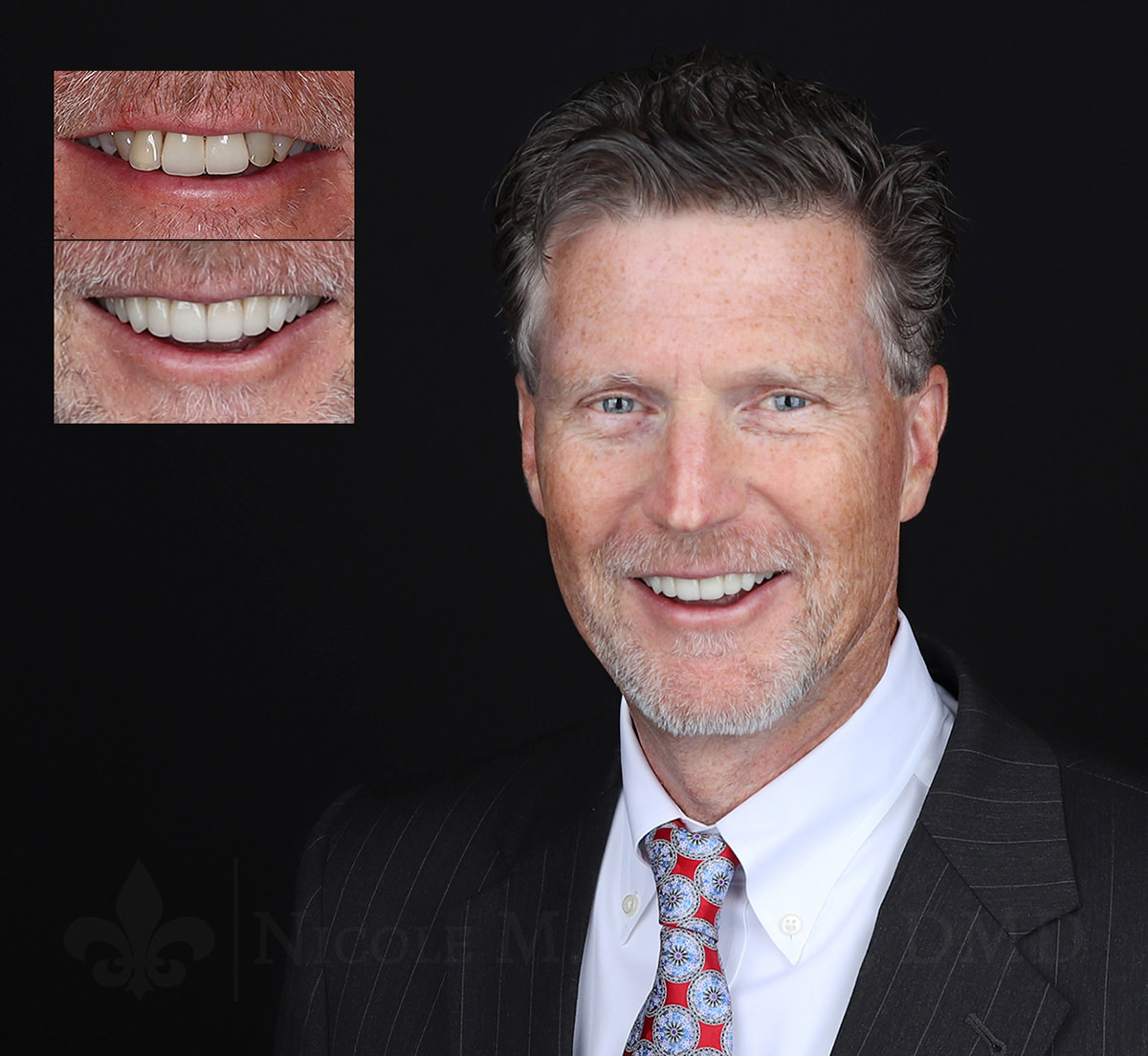 Smile Design for Men - Armour Dentistry
